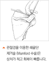 관절경을 이용한 쇄골단 제거술(Mumford 수술)은 상처가 적고 회복이 빠릅니다.
