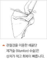 °üÀý°æÀ» ÀÌ¿ëÇÑ ¼â°ñ´Ü Á¦°Å¼ú(Mumford ¼ö¼ú)Àº »óó°¡ Àû°í ȸº¹ÀÌ ºü¸¨´Ï´Ù.