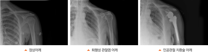 X-ray관절염사진, 퇴행성 관절염 어깨, 역인공관절 치환술 어깨