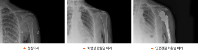X-ray°üÀý¿°»çÁø, ÅðÇ༺ °üÀý¿° ¾î±ú, ¿ªÀΰø°üÀý ġȯ¼ú ¾î±ú