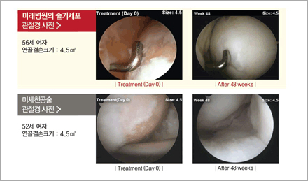 미래병원의 줄기세포치료제 연골재생의 효과 확인에 관한 이미지